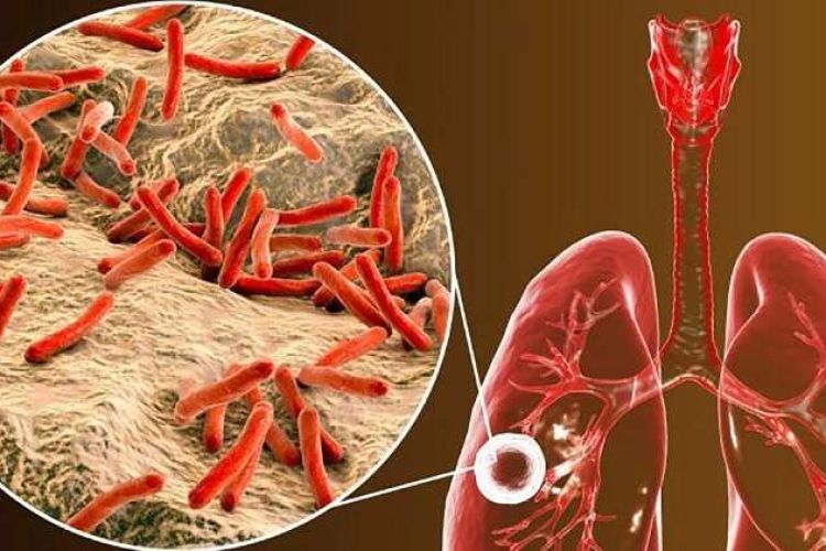 आज विश्व क्षयरोग दिवसः जनचेतनामूलक कार्यक्रमका साथ मनाइँदै